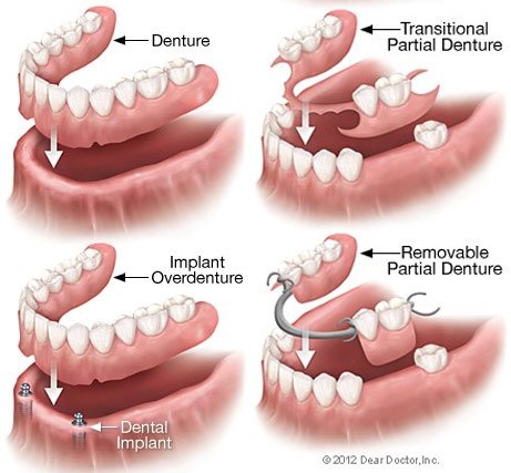 Partial Dentures For Back Teeth Sullivan IL 61951